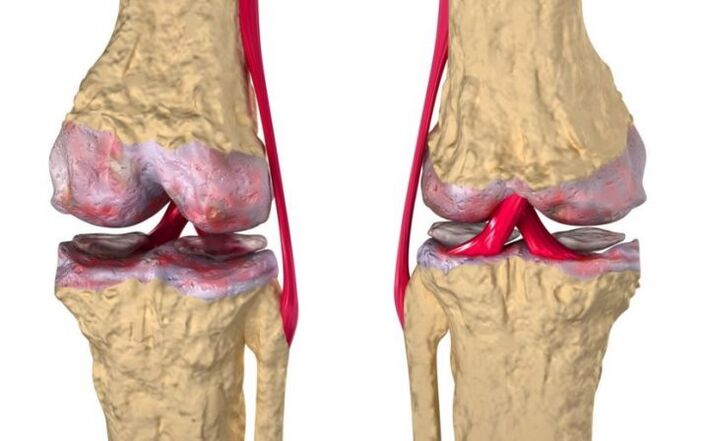 Osteoartritis zgloba koljena